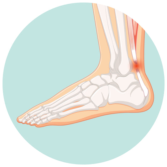 Try A Topical For Tendonitis or Tendinosis
